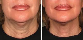 “My Turkey Neck is the Thing of the Past" - <br/>The 4-Month Sculpt & Glow Cycle (Copy)