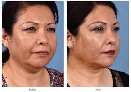 “My Turkey Neck is the Thing of the Past" - <br/>The 4-Month Sculpt & Glow Cycle (Copy)