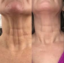 “My Turkey Neck is the Thing of the Past" - <br/>The 4-Month Sculpt & Glow Cycle (Copy)
