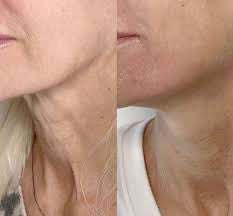 “My Turkey Neck is the Thing of the Past" - <br/>The 4-Month Sculpt & Glow Cycle (Copy)