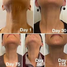 “My Turkey Neck is the Thing of the Past" - <br/>The 4-Month Sculpt & Glow Cycle (Copy)